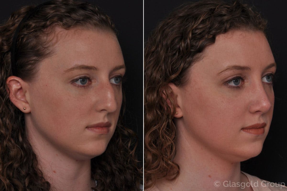 Rhinoplasty Before & After Gallery - Patient 374977 - Image 3