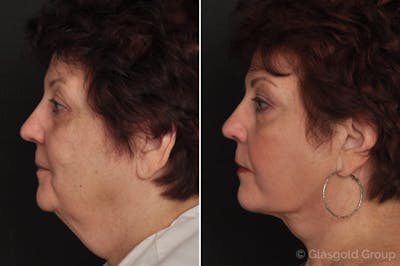 Facelift Before & After Gallery - Patient 302583 - Image 1