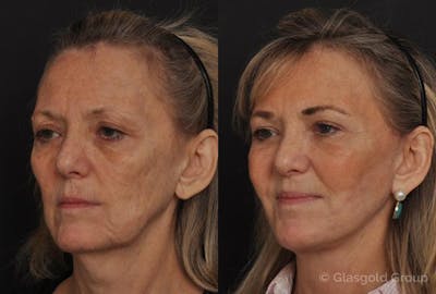 Fat Transfer Before & After Gallery - Patient 196957 - Image 1