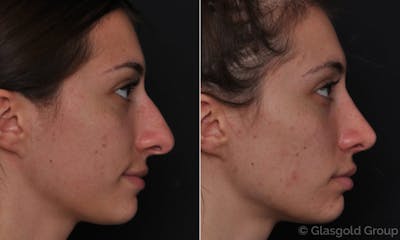 Rhinoplasty Before & After Gallery - Patient 271968 - Image 1