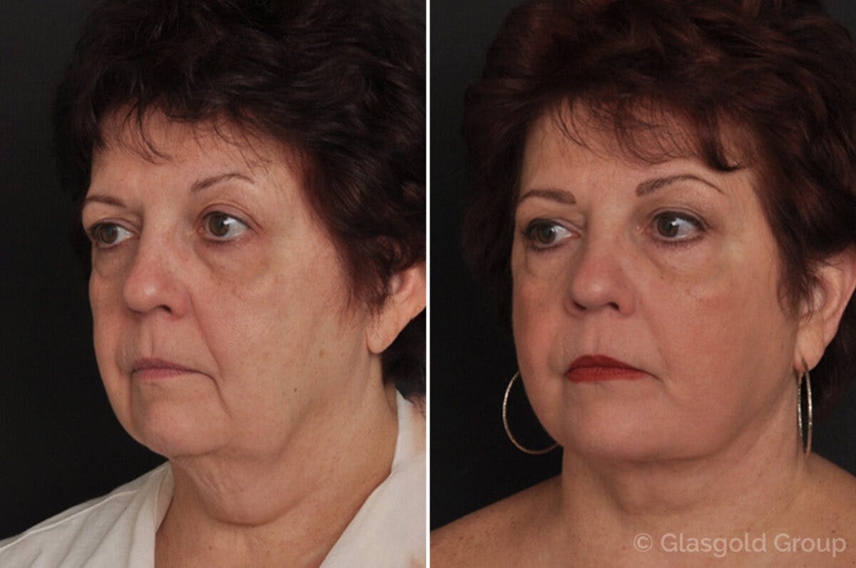 Facelift Before & After Gallery - Patient 302583 - Image 1