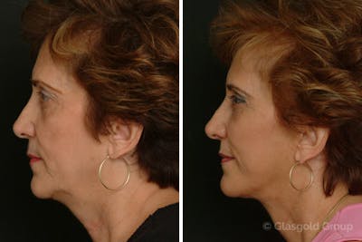 Facelift Before & After Gallery - Patient 240069 - Image 1
