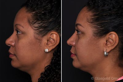 Rhinoplasty Before & After Gallery - Patient 298263 - Image 1