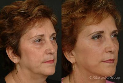 Facelift Before & After Gallery - Patient 240069 - Image 1