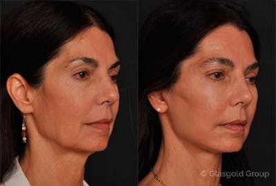 Fat Transfer Before & After Gallery - Patient 453132 - Image 1