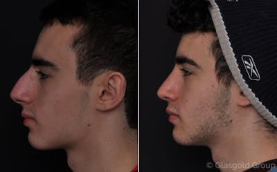 Rhinoplasty Before & After Gallery - Patient 366089 - Image 1