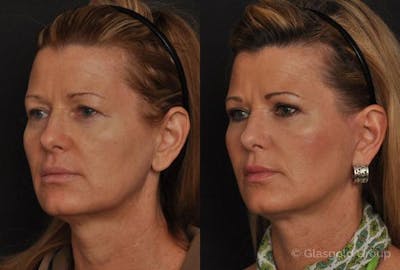 Fat Transfer Before & After Gallery - Patient 415771 - Image 1