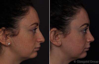 Rhinoplasty Before & After Gallery - Patient 189451 - Image 1