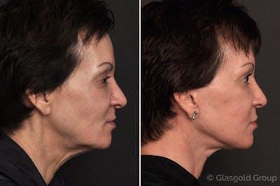 Facelift Before & After Gallery - Patient 163369 - Image 1