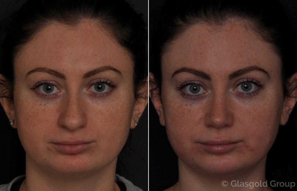 Rhinoplasty Before & After Gallery - Patient 189451 - Image 2