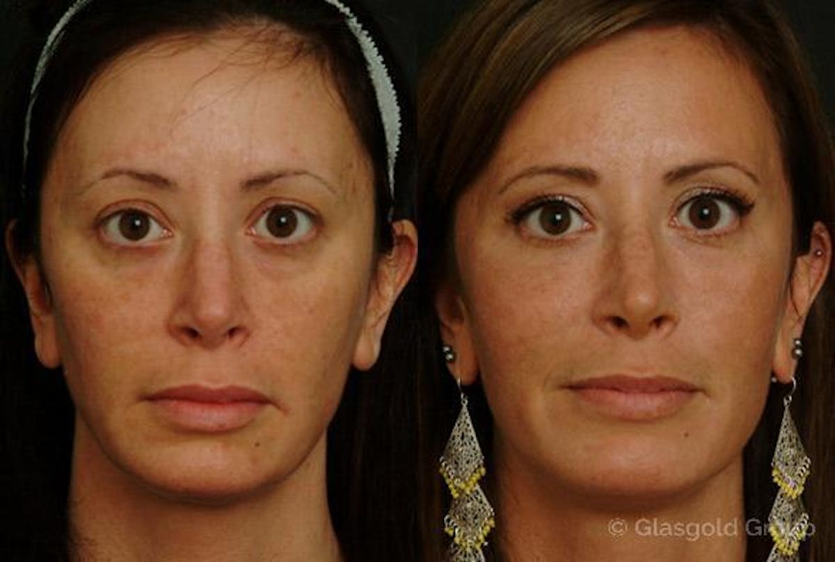 Fat Transfer Before & After Gallery - Patient 110167 - Image 2