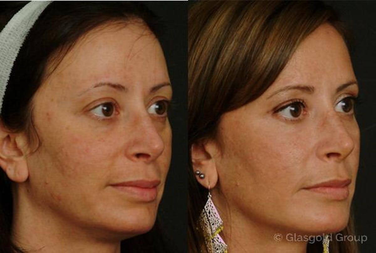 Fat Transfer Before & After Gallery - Patient 110167 - Image 3