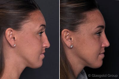 Rhinoplasty Before & After Gallery - Patient 319131 - Image 1