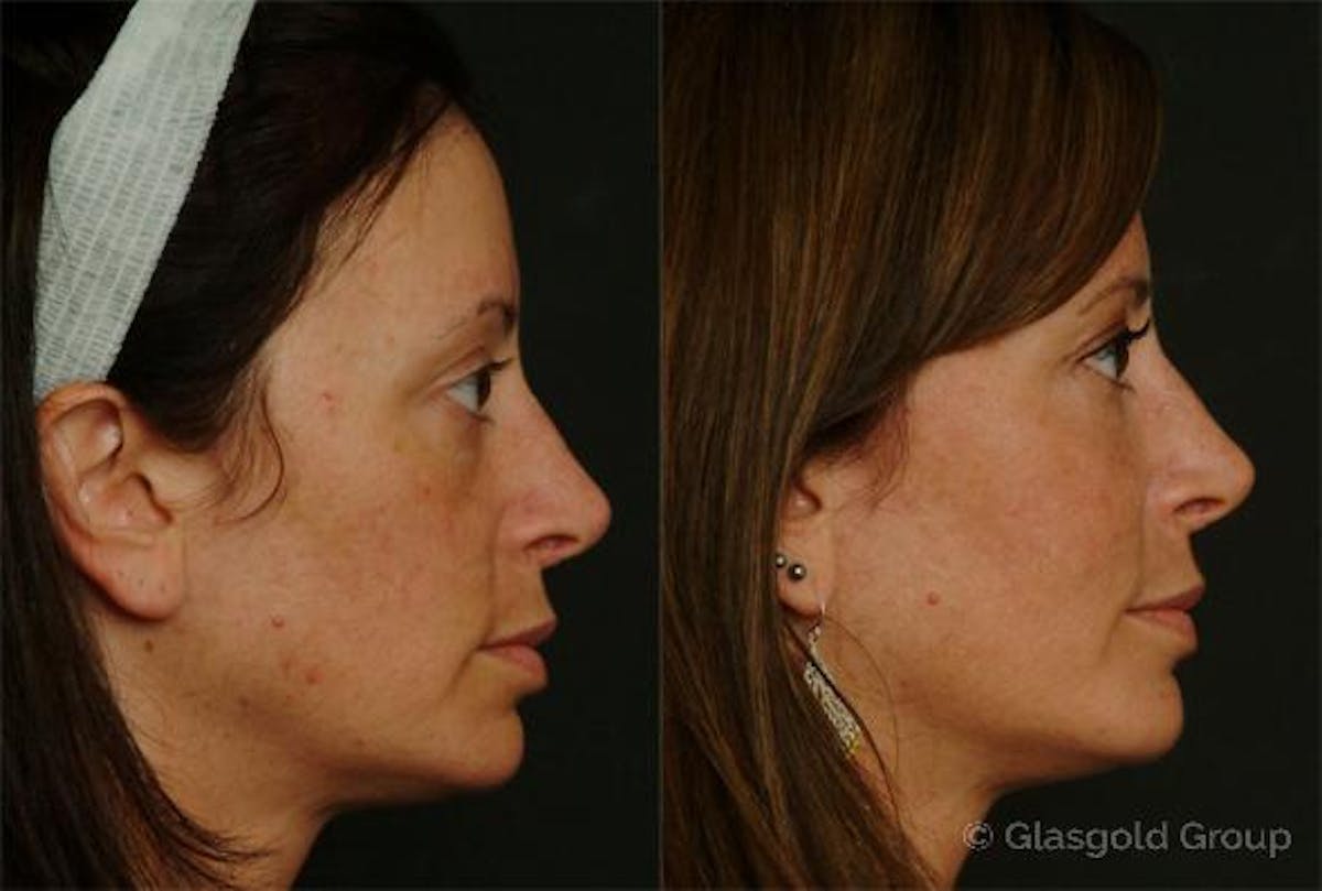 Fat Transfer Before & After Gallery - Patient 110167 - Image 1