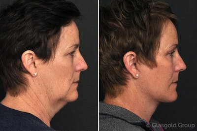 Facelift Before & After Gallery - Patient 130772 - Image 1