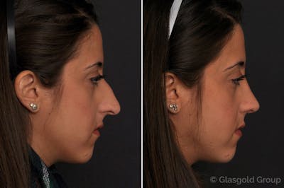 Rhinoplasty Before & After Gallery - Patient 701986 - Image 1