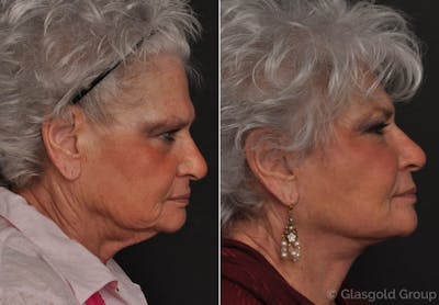 Facelift Before & After Gallery - Patient 353289 - Image 1