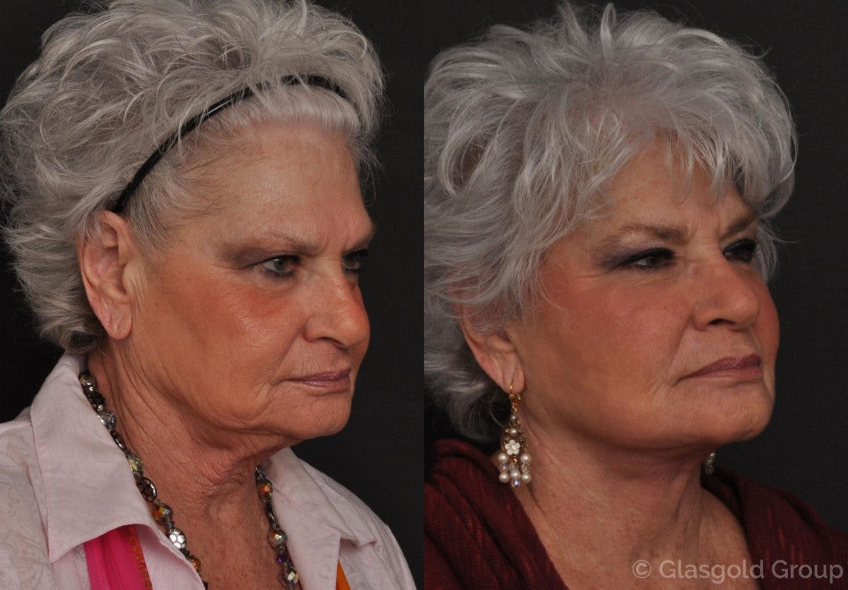 Facelift Before & After Gallery - Patient 353289 - Image 1