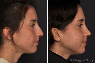 Rhinoplasty Before & After Gallery - Patient 942805 - Image 1