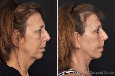Facelift Before & After Gallery - Patient 378188 - Image 1