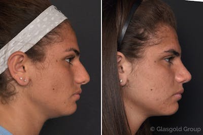Rhinoplasty Before & After Gallery - Patient 752459 - Image 1