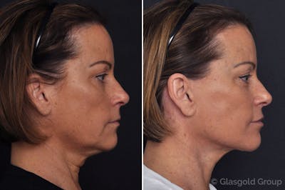Facelift Before & After Gallery - Patient 288844 - Image 1