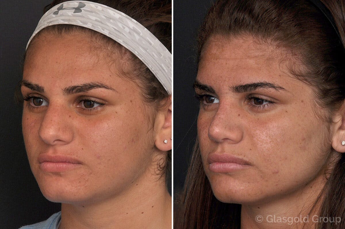 Rhinoplasty Before & After Gallery - Patient 752459 - Image 3