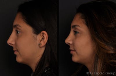 Rhinoplasty Before & After Gallery - Patient 191144 - Image 1
