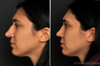 Rhinoplasty Before & After Gallery - Patient 147675 - Image 1