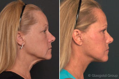 Facelift Before & After Gallery - Patient 213453 - Image 1