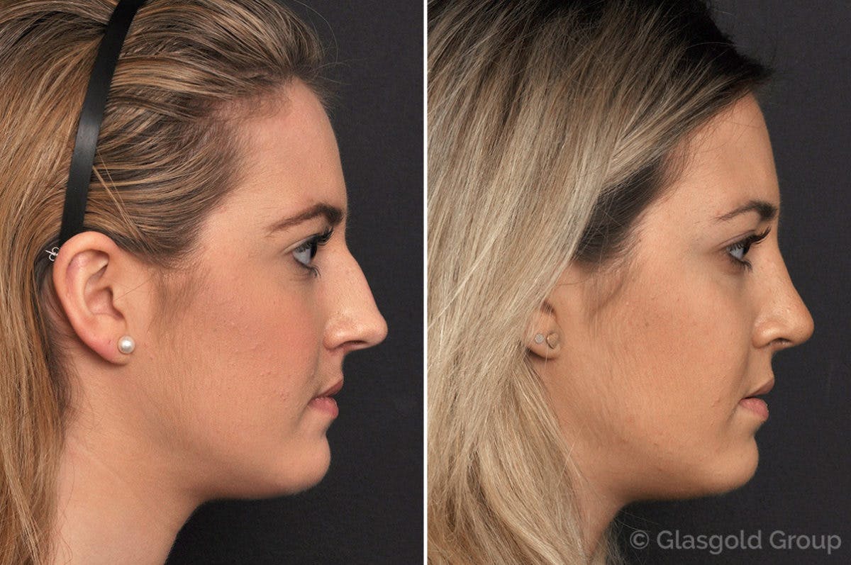 Rhinoplasty Before & After Gallery - Patient 334099 - Image 1