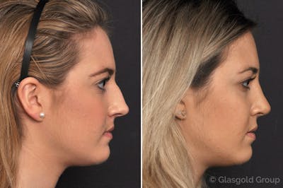 Rhinoplasty Before & After Gallery - Patient 334099 - Image 1