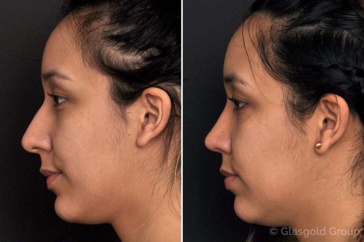 Rhinoplasty Before & After Gallery - Patient 384888 - Image 1