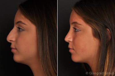 Rhinoplasty Before & After Gallery - Patient 229992 - Image 1