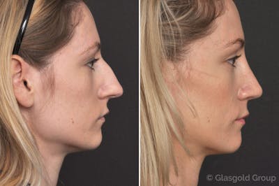 Rhinoplasty Before & After Gallery - Patient 568495 - Image 1