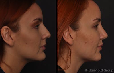 Rhinoplasty Before & After Gallery - Patient 344595 - Image 1