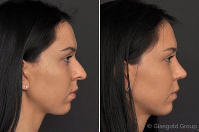 Rhinoplasty Before & After Gallery - Patient 113941 - Image 1