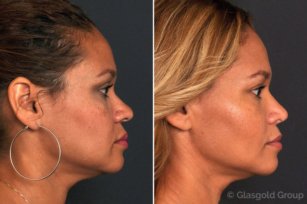 Rhinoplasty Before & After Gallery - Patient 399019 - Image 1