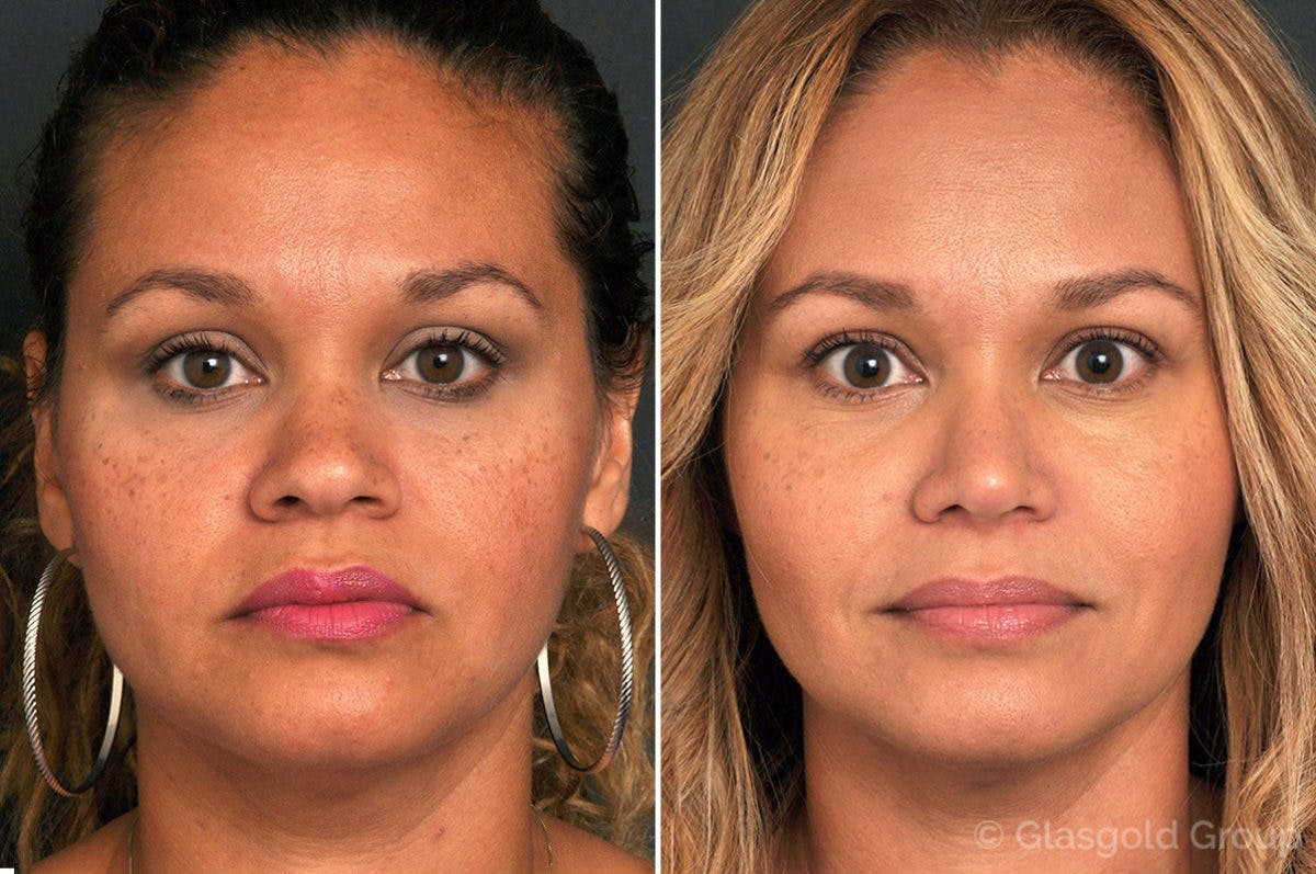 Rhinoplasty Before & After Gallery - Patient 399019 - Image 2