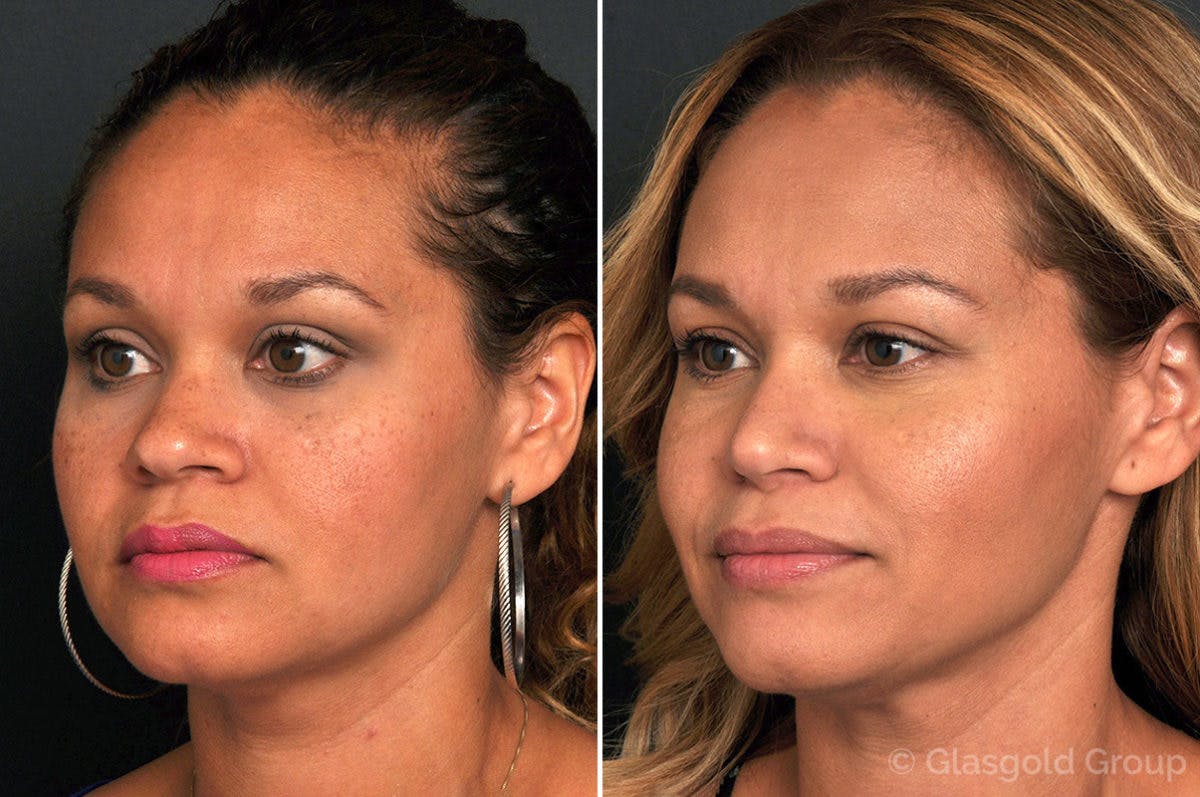 Rhinoplasty Before & After Gallery - Patient 399019 - Image 3