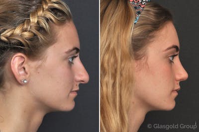 Rhinoplasty Before & After Gallery - Patient 255675 - Image 1