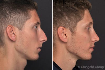 Rhinoplasty Before & After Gallery - Patient 151075 - Image 1
