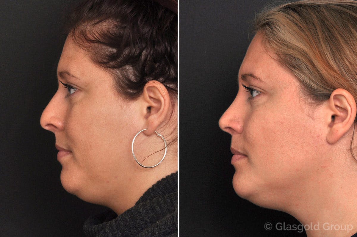 Rhinoplasty Before & After Gallery - Patient 120640 - Image 1