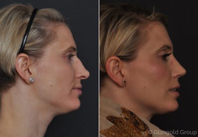Rhinoplasty Before & After Gallery - Patient 382581 - Image 1