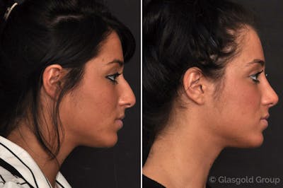Rhinoplasty Before & After Gallery - Patient 150775 - Image 1