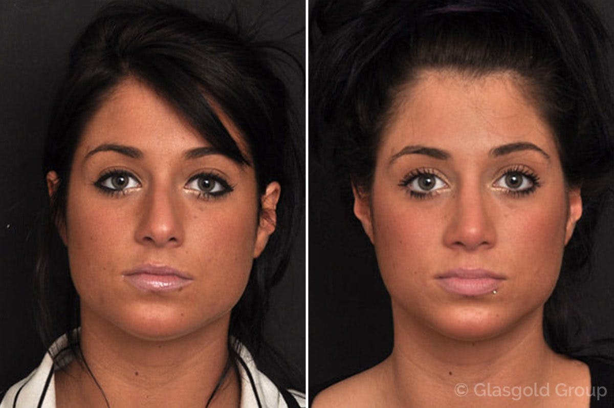 Rhinoplasty Before & After Gallery - Patient 150775 - Image 2