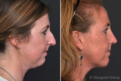 Rhinoplasty Before & After Gallery - Patient 349401 - Image 1