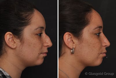 Rhinoplasty Before & After Gallery - Patient 211884 - Image 1
