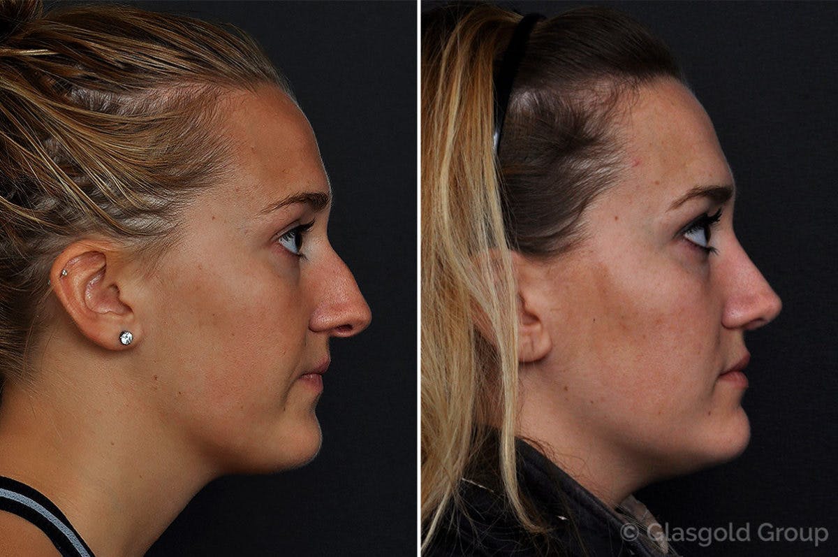 Rhinoplasty Before & After Gallery - Patient 198383 - Image 1