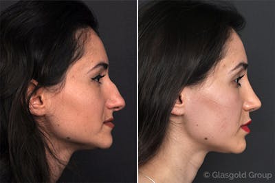 Rhinoplasty Before & After Gallery - Patient 240671 - Image 1